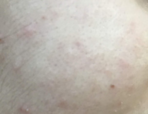 Face Acne Problem