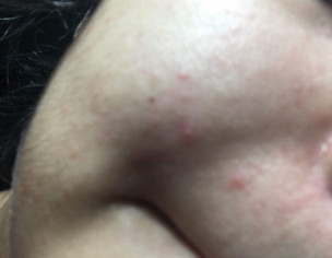 Face Acne Problem