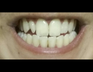 Teeth Bleed And Black Gap