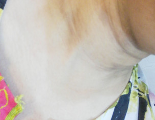 Hypigmentation On Neck
