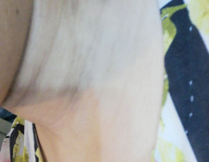 Hypigmentation On Neck