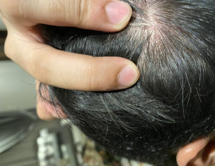 Scalp Pimples