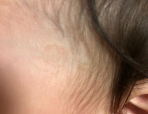 Skin Decoloration 