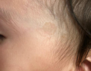 Skin Decoloration 