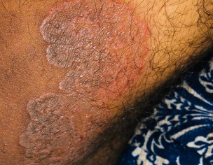 Rashes On Thighs, Hips