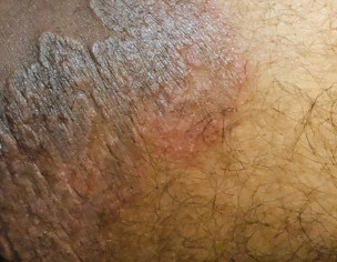 Rashes On Thighs, Hips