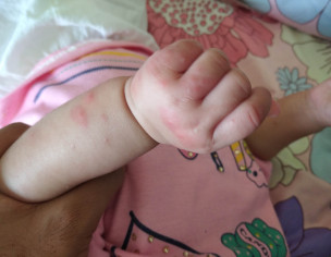 Rashes (reddish Pimples Type Dots) 