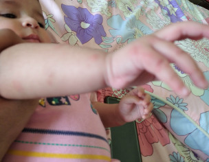 Rashes (reddish Pimples Type Dots) 