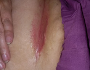 Rash Sort Of Something 