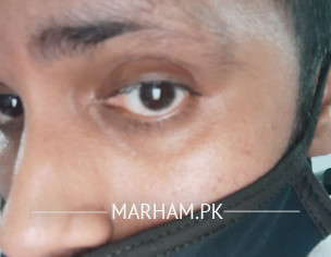 Hair Falling Issue At Eyebrow