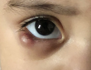 Eye Stye Or Pimple