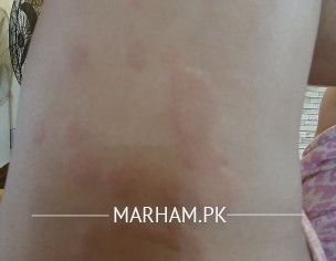 Help Me Skin Allergies