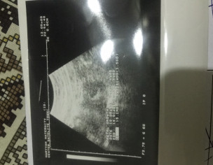 No Fetal Pole At 5 Weeks 