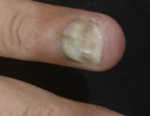 Problem In Nail/finger