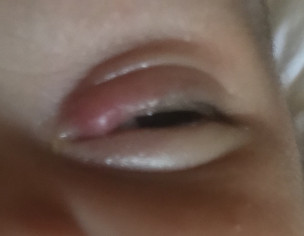 Eye Chlazion 