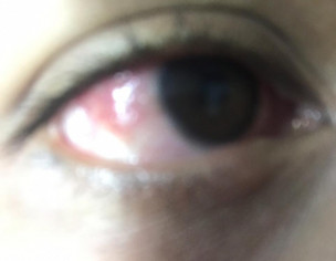 Redness In Left Eye