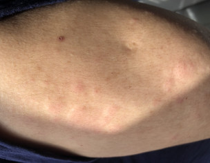 Extremely Itchy Bumps On Body 