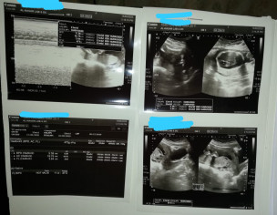 Gynae Problem Pregnancy