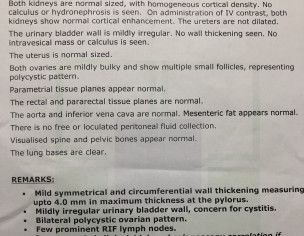 Tightness In Upper Stomach