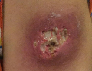 Skin Infection Cellulitis 