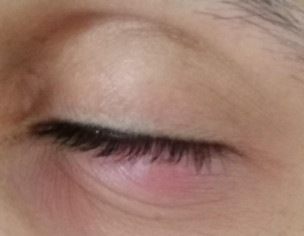 Swollen Eye Lid 