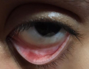 Eye Swelling