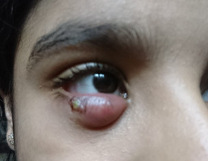 Pus Below Eye