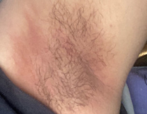 ARMPIT Rash