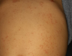 Allergy On Belly Only