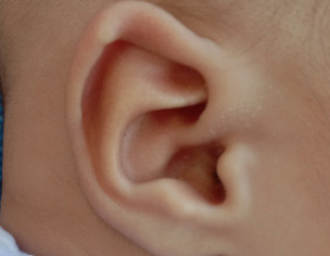 Ear Shape, Folded Helix