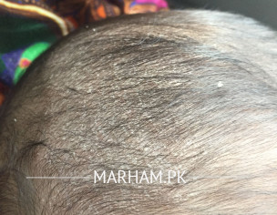 Baby Scalp 