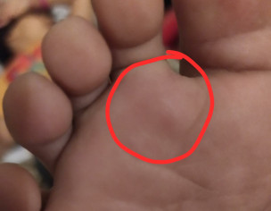 Swelling Just Below Toes