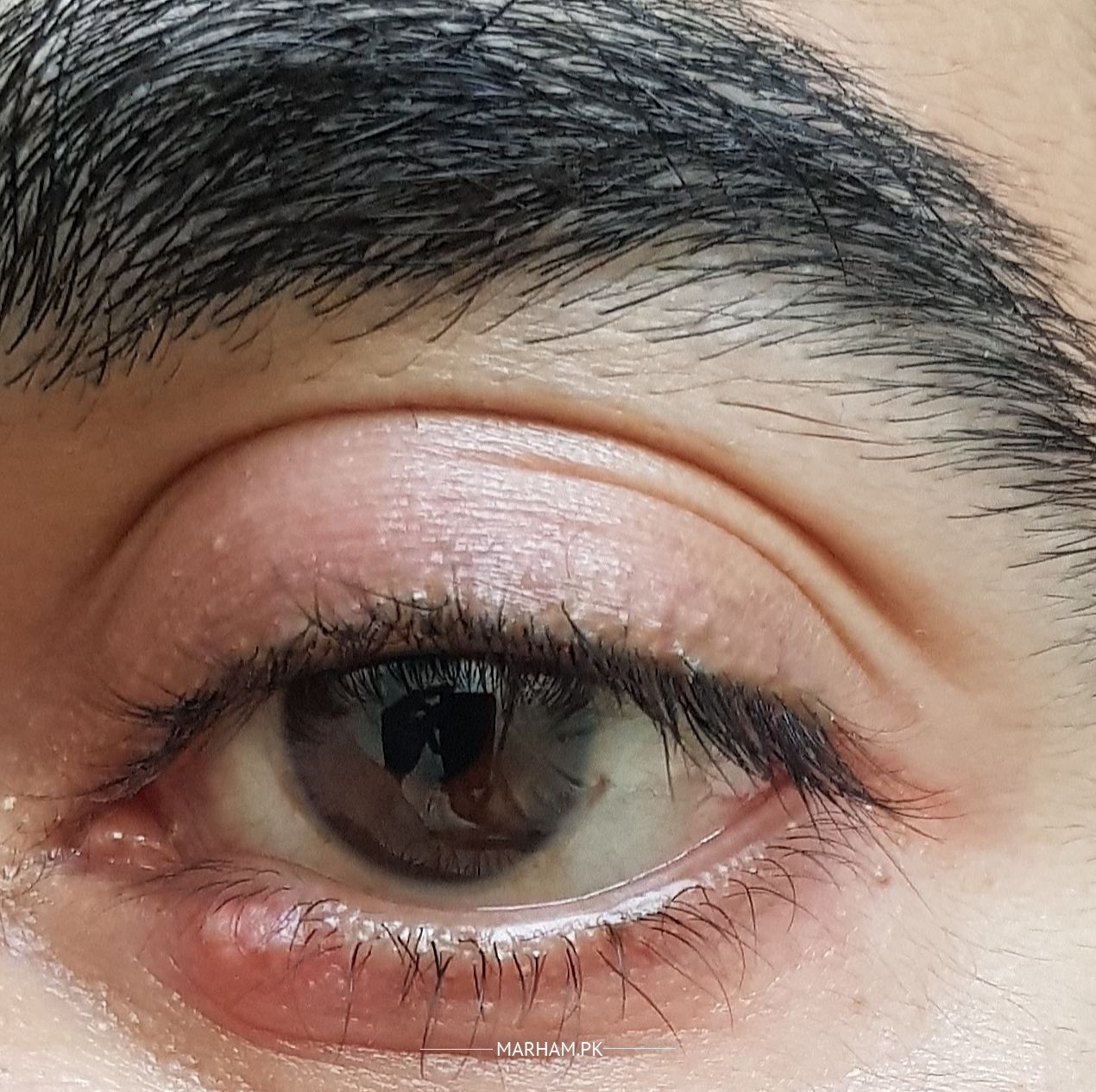 swollen eyelid