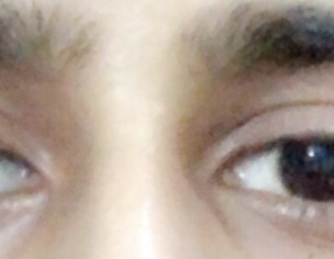 Ptosis, Weird Eye Lid