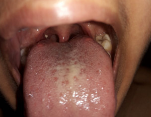 White Solid Component Inside Mouth