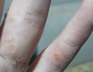 Acne On Hands 