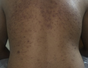 Acne At Back (kamar)