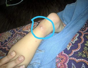 Skin Insect Bite