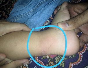 Skin Insect Bite