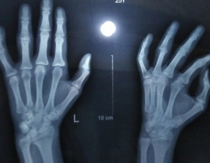 Proximal Interphlengeal Joint Dislocation