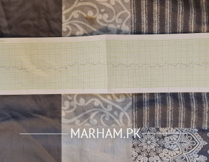 Heart SVT Or Panic Disorder