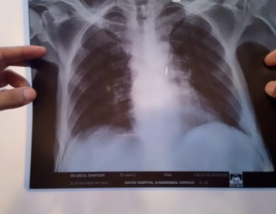 Possible Lung Problem