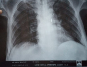 Possible Lung Problem