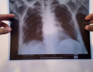 Possible Lung Problem