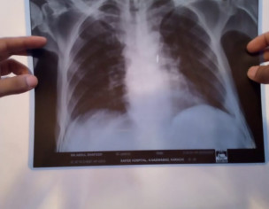 Possible Lung Problem