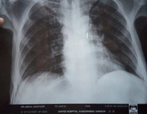 Possible Lung Problem
