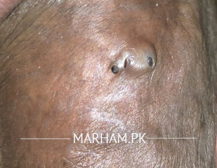 Scabies/lump On Penis