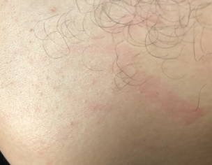 Raised Urticeria &amp; Plain Red Bruises 