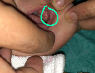 Teething Or Not