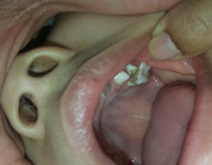 Tooth Decay/ Root Canal